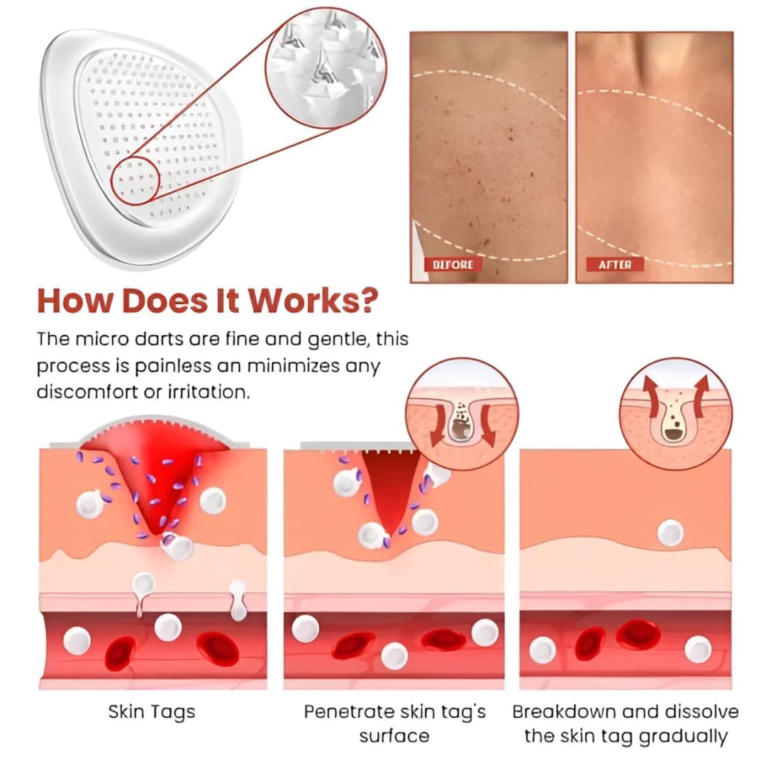 SkinSmooth™ – Skin Tag Removal Patch (Pack of 2)