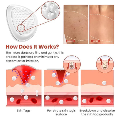 DermaSmooth Skin Tag Remover Patch – Painless Skin Care Solution